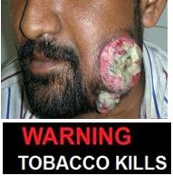India 2013 Health Effects Mouth (Smokeless Tobacco Products) - diseased organ, gross 3